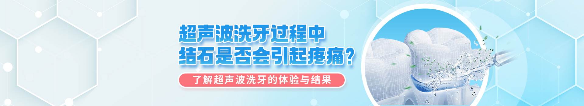 超声波洗牙过程中结石是否会引起疼痛？了解超声波洗牙的体验与结果。