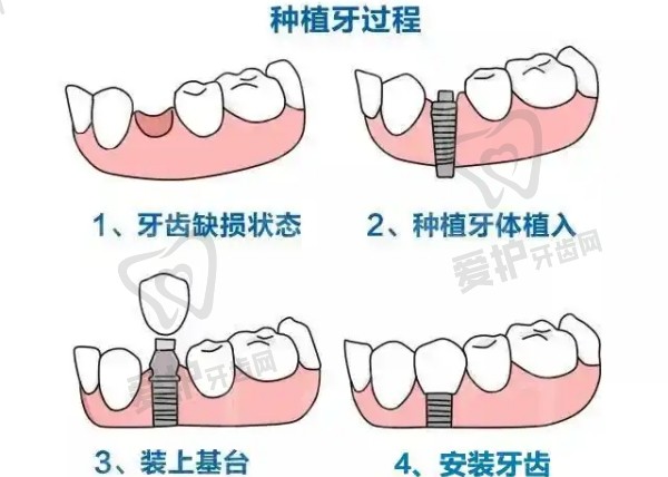 韩国登腾(Dentium)种植系统