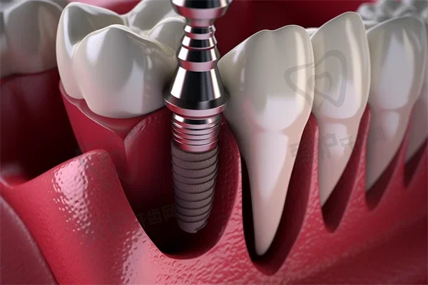 种植牙五大风险危害整理盘点 