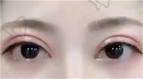 重庆华美整形外科医院谷琪纳米重睑双眼皮祛皮祛脂4999元起，微创隐痕+个性设计打造妈生美眼