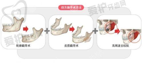 沈阳元辰陈军做面部除皱手术的沟通与关怀