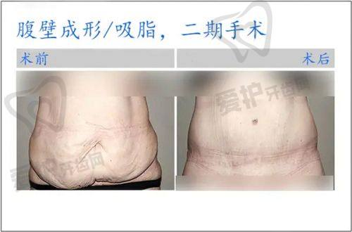 哈尔滨治疗疤痕疙瘩的医院推荐
