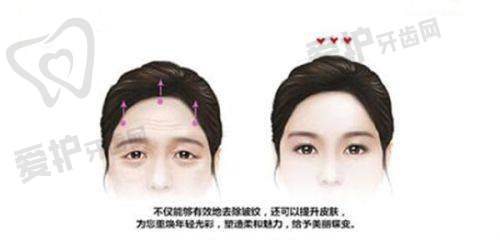 郑州王杨医生眼袋修复卧蚕真实范例