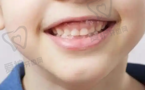 成都医大口腔医院王亚楠时代天使隐形矫正22800元起，美观舒适还能提升面部美感！