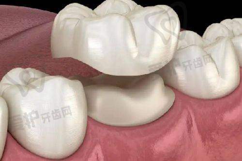 珠海海精灵口腔半口活动义齿修复5580元起，个性化方案+优质材料+贴心服务助老人重享口福