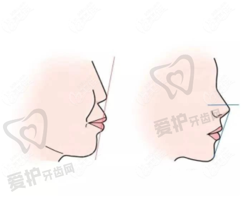 珠海海精灵口腔做后磨牙根管治疗的具体优势
