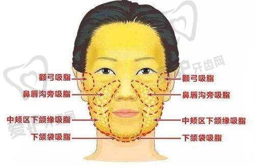 打瘦脸针需要做哪些术前准备？