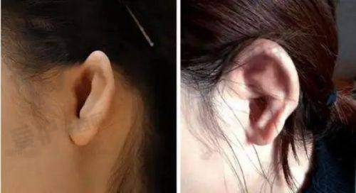 瘦脸针有替代方法吗？