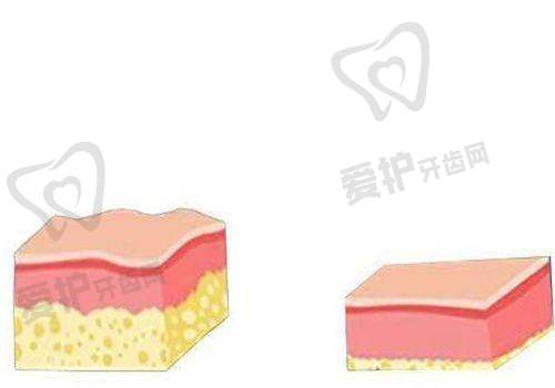 打瘦脸针后多久开始见效？