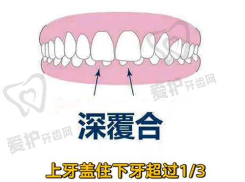 恒牙蛀牙,需要补牙吗?