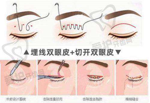 长沙雅美袁妍妍提到的玻尿酸改善面部凹陷是怎样的?