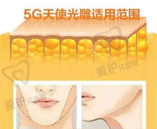 哪些人适合打瘦脸针？