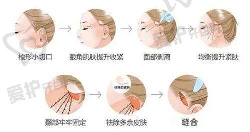 消除抬头纹需要注意什么？