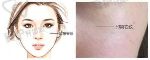 做完嘟嘟唇后需要注意什么?