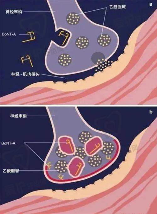 嘟嘟唇的手术费用大概是多少?