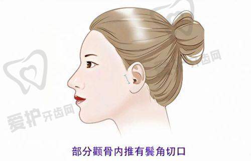哪些人适合做嘟嘟唇?
