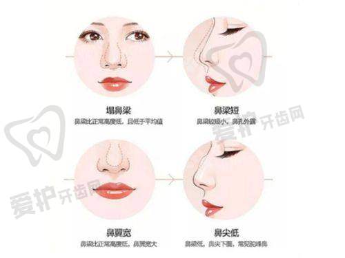 自体脂肪填充改善面部凹陷的原理和优势是什么?