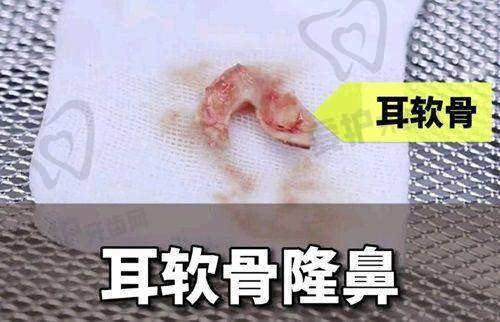 医院做结构派鼻修复项目的具体优势