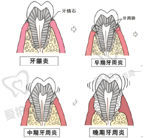 补牙材料的选择