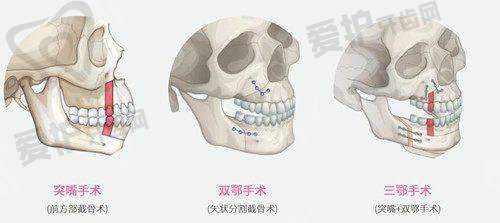西安画美做眼部修复项目的具体优势