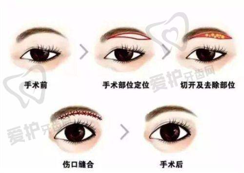 选择伊美尔的优势与建议