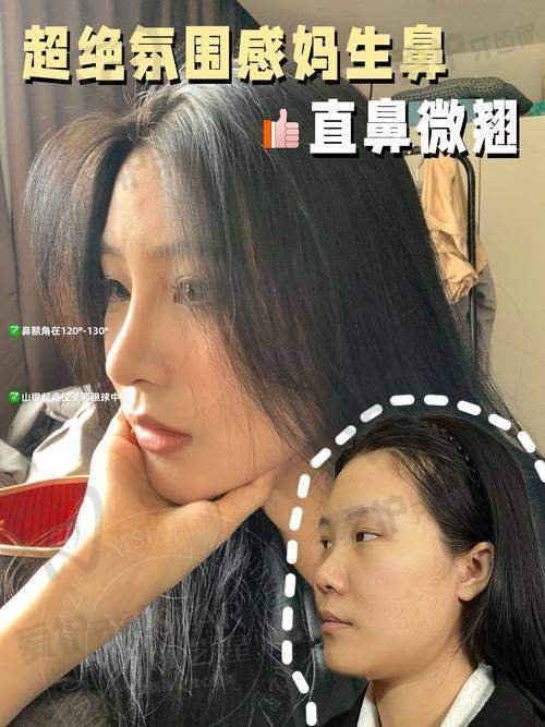 四川华美紫馨美容医院做耳软骨综合隆鼻的具体优势