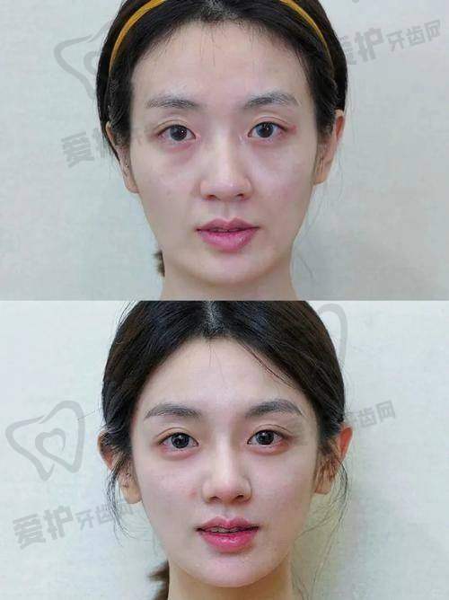 眼部填充有哪些注意事项？