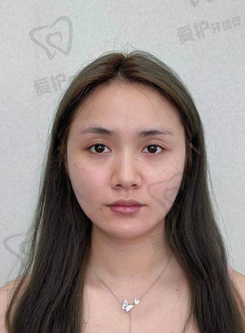 如何根据自身情况选择适合的眼部填充材料？