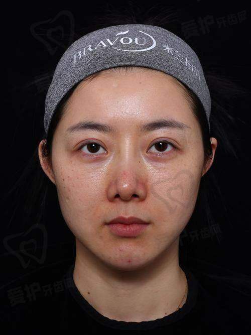 眼部填充使用胶原蛋白的成效和特点又如何？