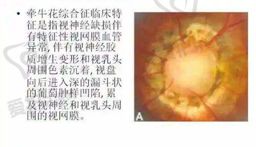 北京普瑞华德眼科医院的白内障治疗技术