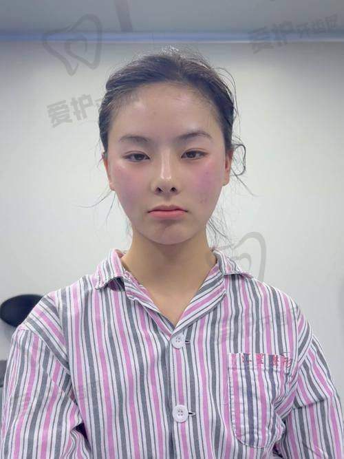 医院/医生做颧骨/颧弓整形术的具体优势