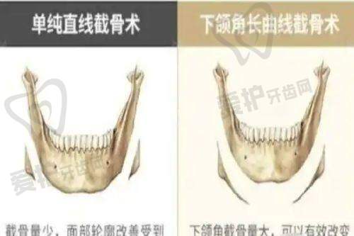 上海华美医疗美容医院做手术缩鼻尖的具体优势