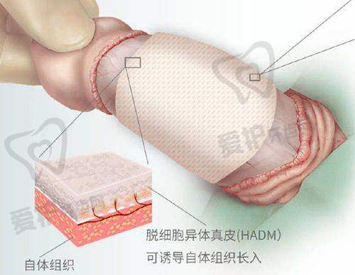 上海华美医疗美容医院做耳软骨鼻综合项目的优势