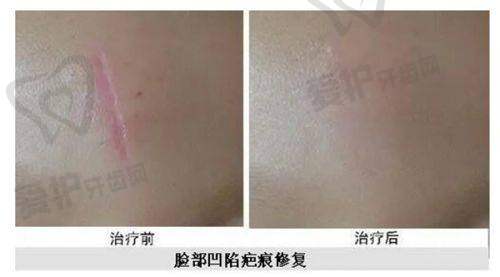 上海华美医疗美容医院做腹部吸脂的优势