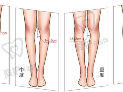 美杜莎双眼皮是平行的吗，和普通双眼皮形状选择有什么不同？