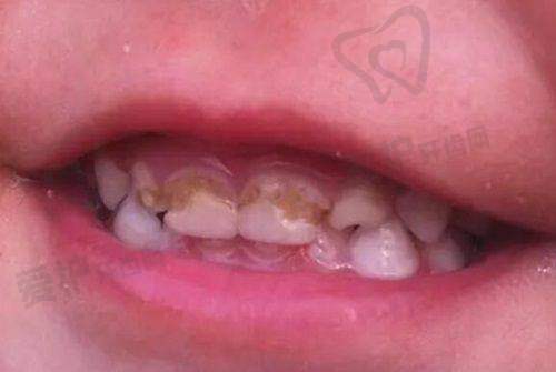 医院做后磨牙根管治疗的具体优势