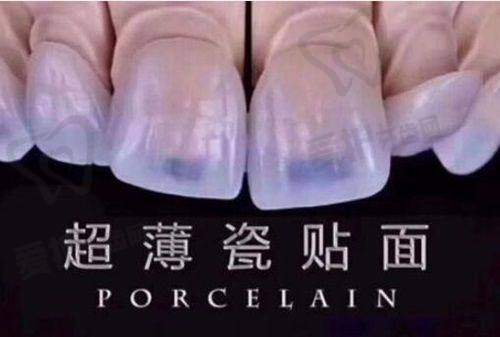 汕头汕美口腔刘佳金属托槽牙齿矫正 5743 元起，精准矫正牙歪等问题，技术优服务好！