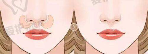 美杜莎双眼皮原理是什么，和普通双眼皮手术原理一样吗？