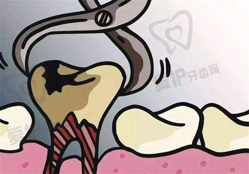 医院做上颌正位智齿拔除项目的优势