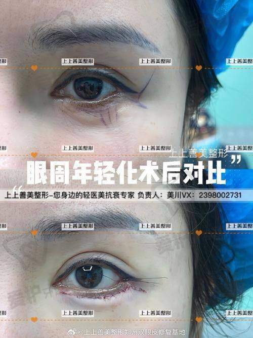 石家庄美莱整形医院做微创眼综合项目的具体优势