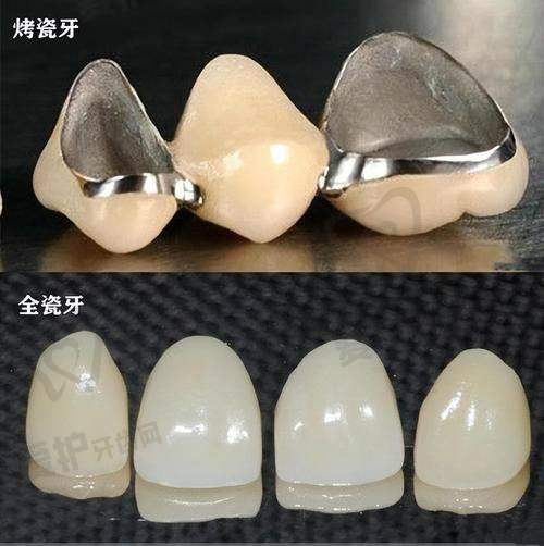 湛江致美口腔医院做爱尔创全瓷牙冠项目的具体优势