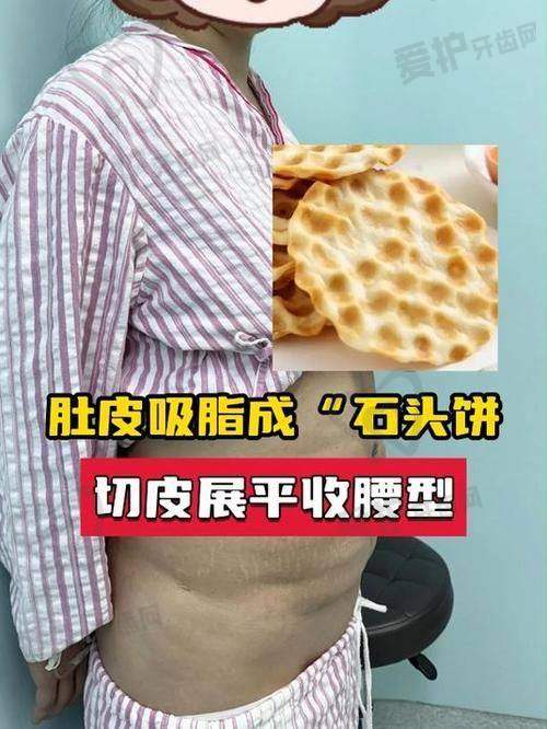 贵州利美康外科医院文明大腿吸脂2628元起，技术优效果好，术后跟踪完善助美腿塑形