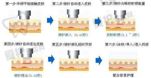 淮安华美黄金微针面部/颈部二选一仅1810元起，改善痘坑细纹，专业团队服务佳