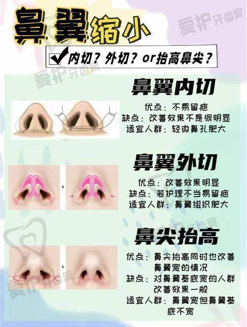 贵州利美康外科医院做鼻头鼻翼缩小项目的优势