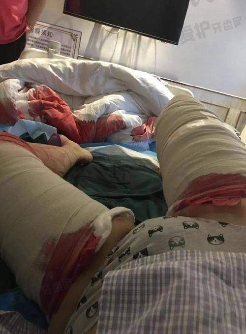 淮安华美大腿吸脂6750元起赠塑身衣，先进技术+专业团队助你拥有纤细美腿