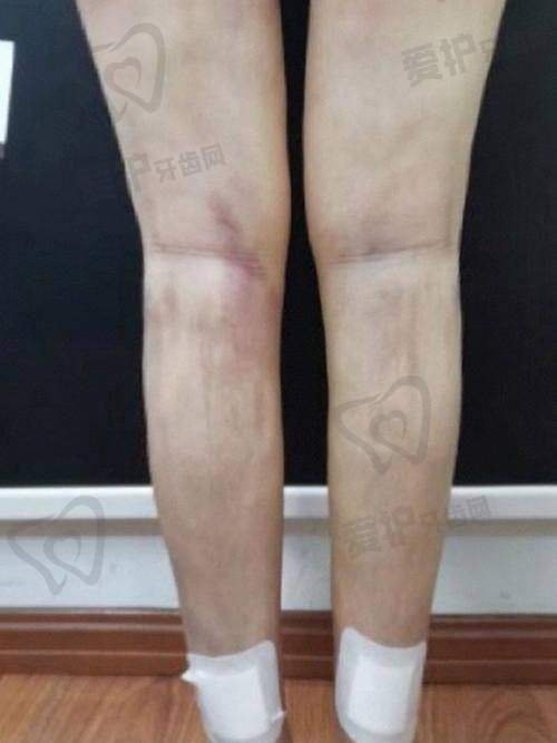 淮安华美做大腿吸脂项目的具体优势