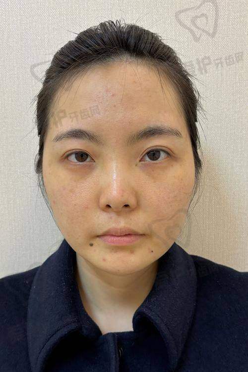 杭州瑞丽医疗美容医院做铂金瑞蓝玻尿酸项目的具体优势