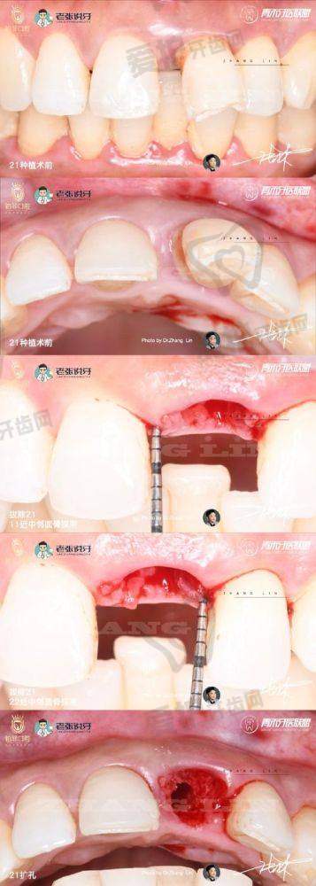 湛江致美口腔医院做韩国仕诺康种植牙项目的优势