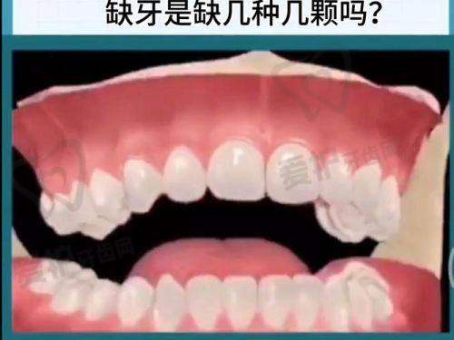 陈建良医生做韩国仕诺康种植牙项目的优势