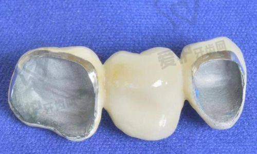 汕头奥诗卡口腔医院做生物合金烤瓷牙冠修复的具体优势
